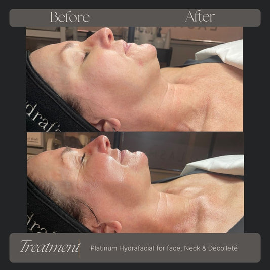 Signature Hydrafacial