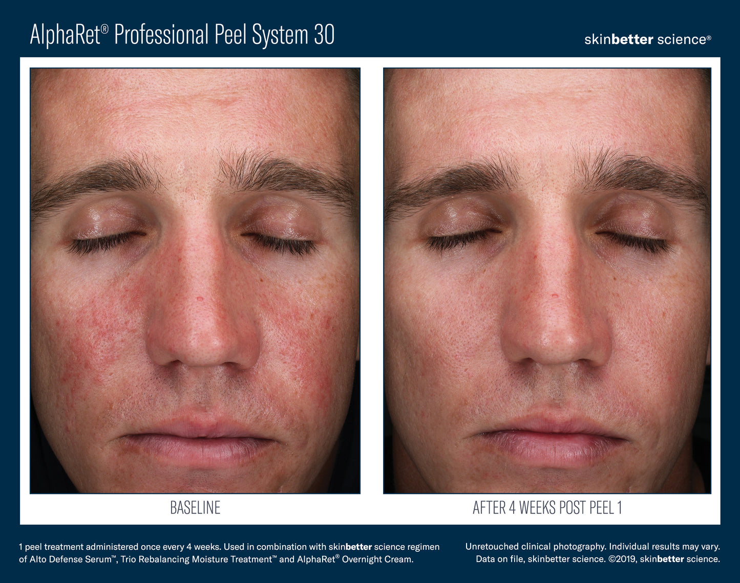 Skinbetter AlphaRet Peel