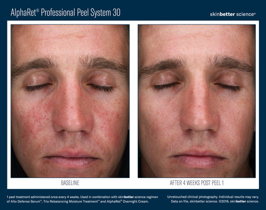 Skinbetter AlphaRet Peel