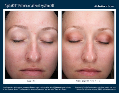 Skinbetter AlphaRet Peel