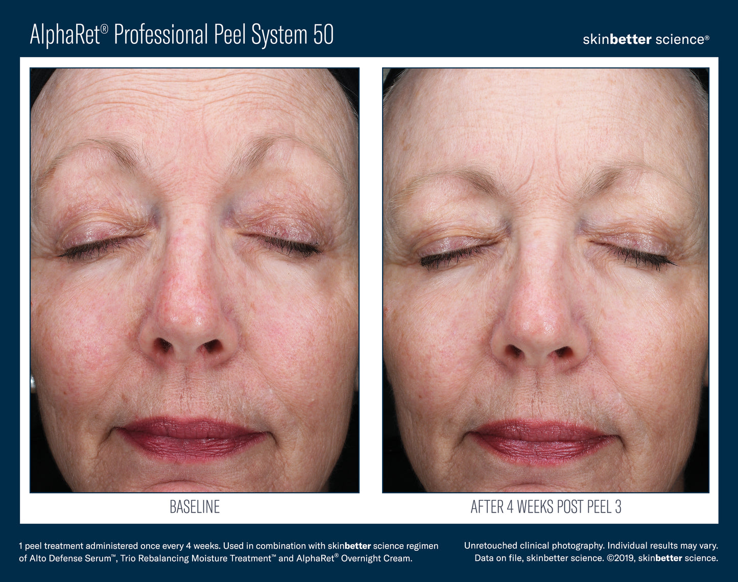 Skinbetter AlphaRet Peel