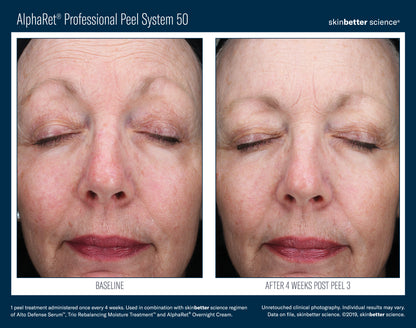 Skinbetter AlphaRet Peel