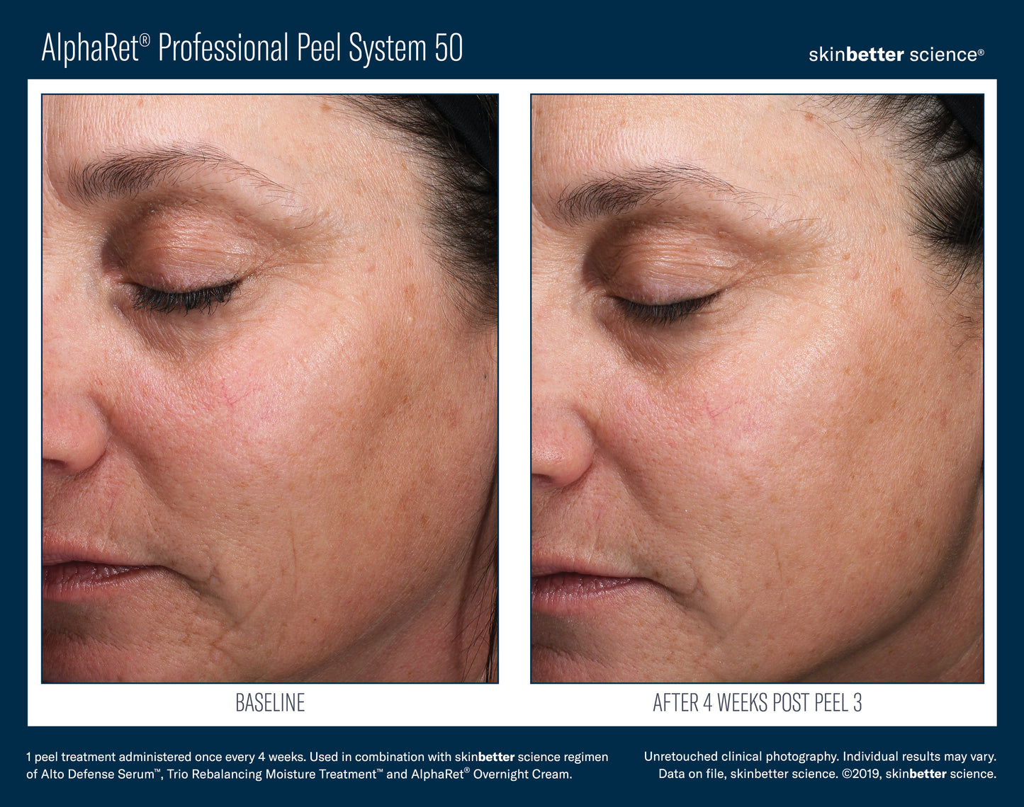 Skinbetter AlphaRet Peel