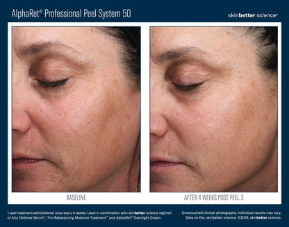 Skinbetter AlphaRet Peel