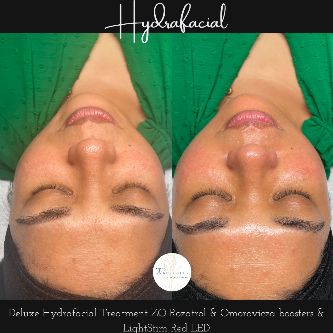 Deluxe Hydrafacial