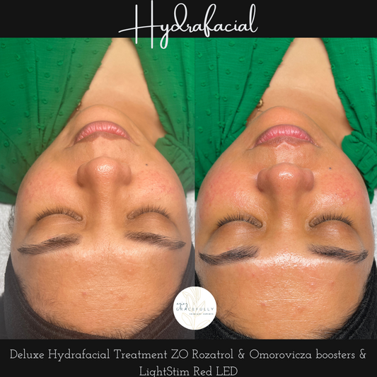 Deluxe Hydrafacial