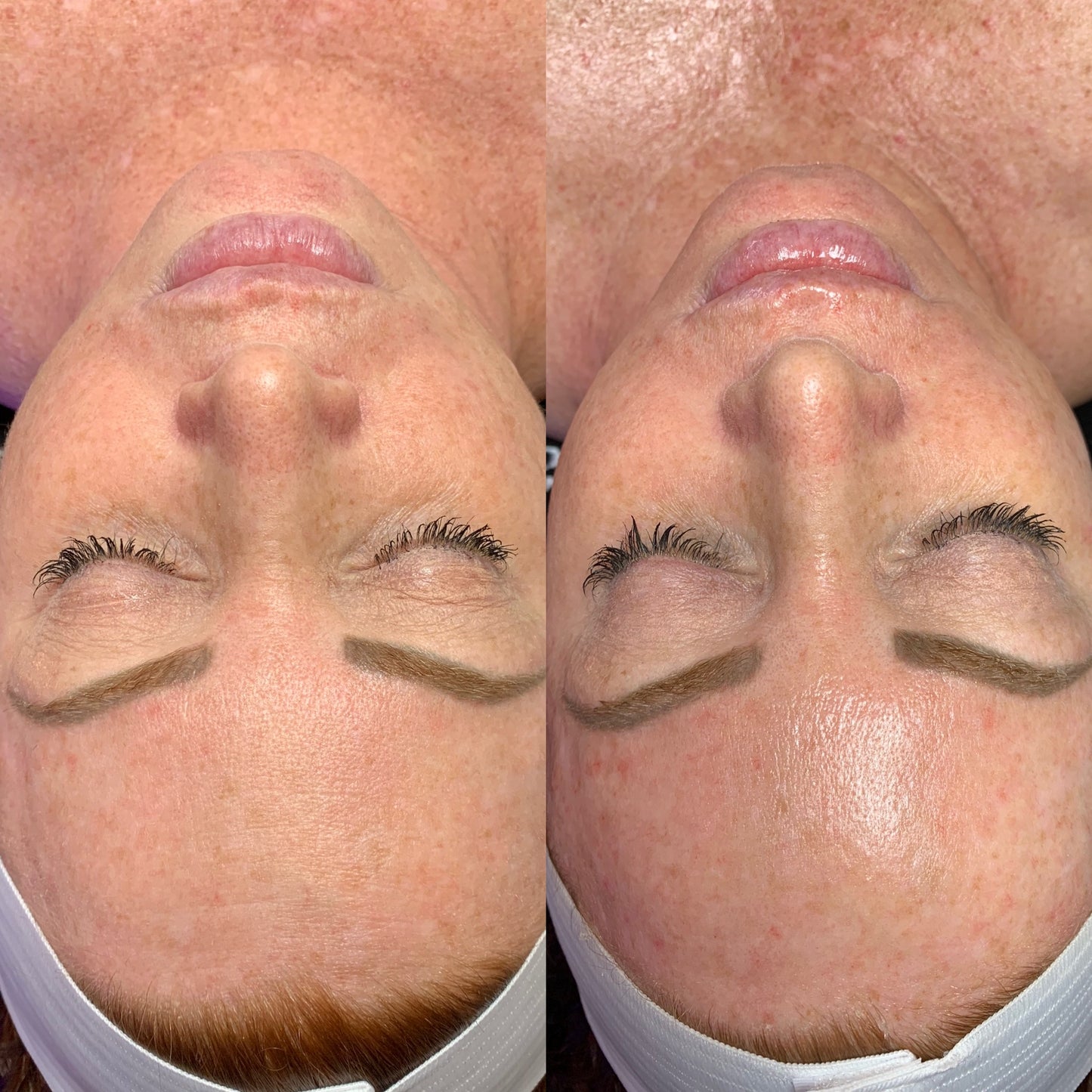 Deluxe Hydrafacial