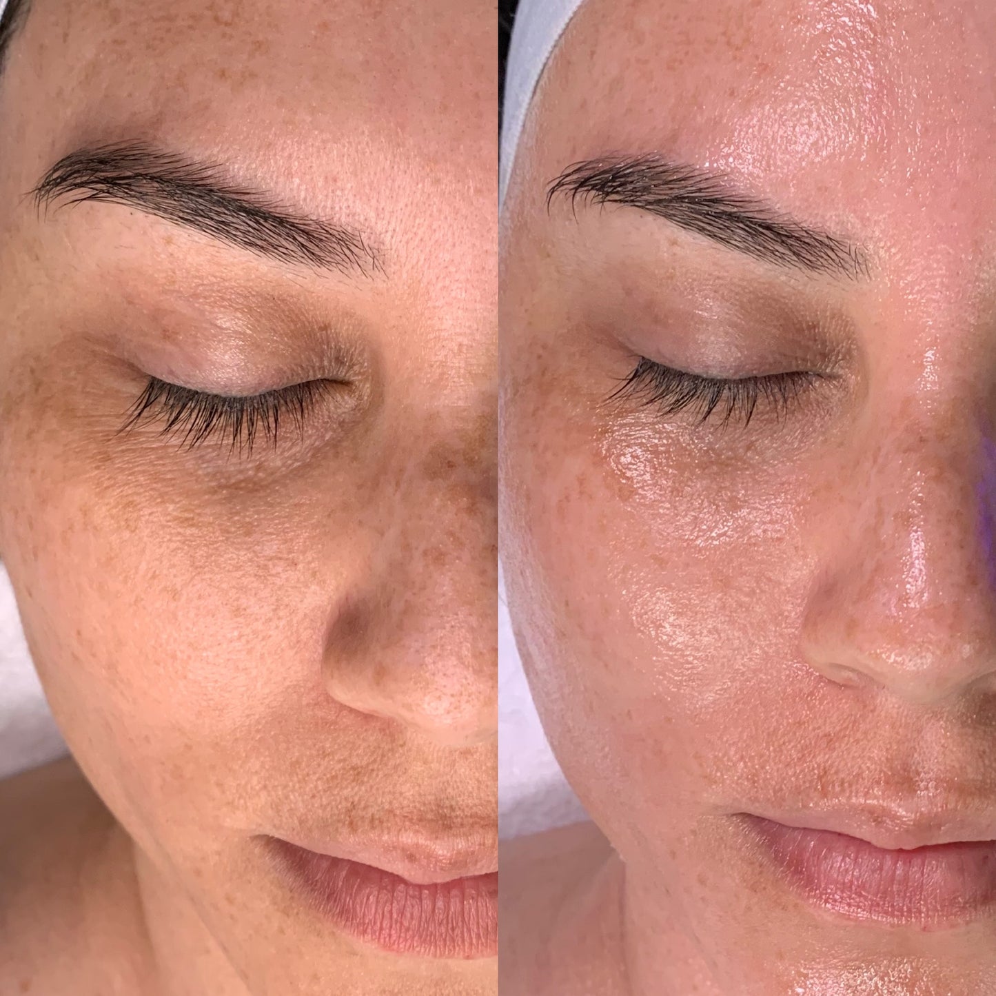 Platinum Hydrafacial
